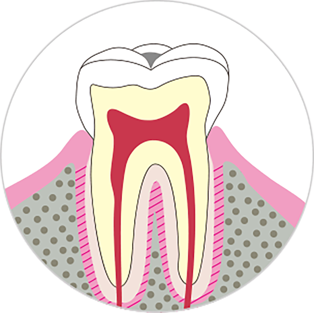 エナメル質まで進行したむし歯