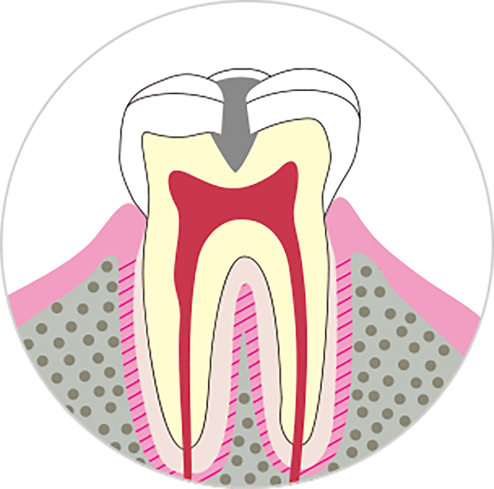 象牙質まで進行したむし歯