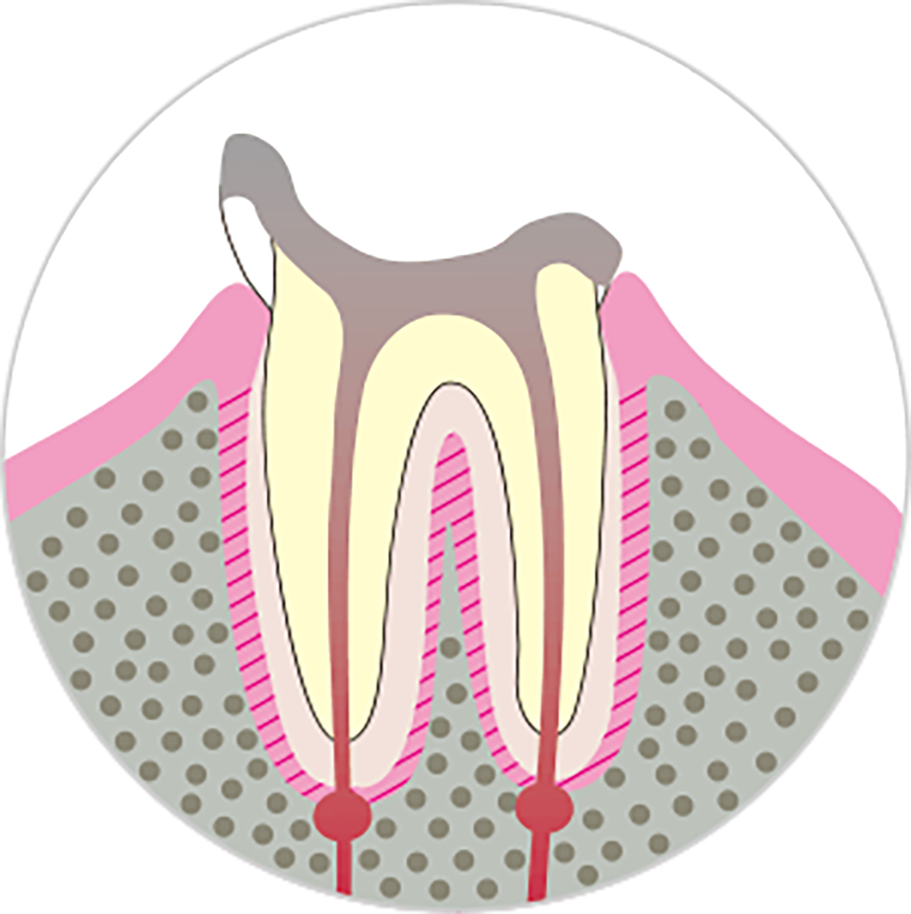 歯の大部分が失われたむし歯