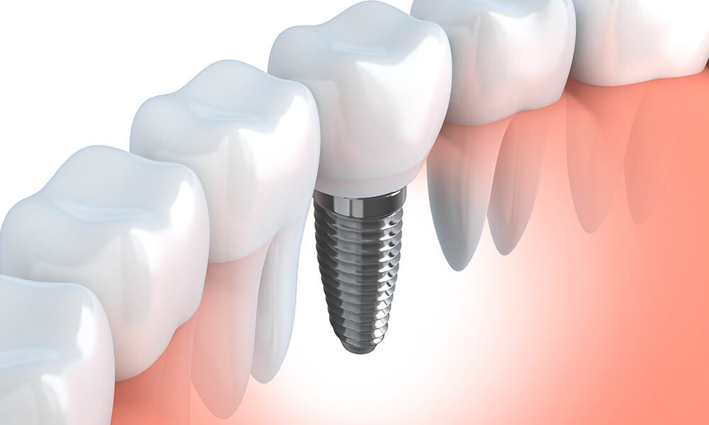 インプラントとは