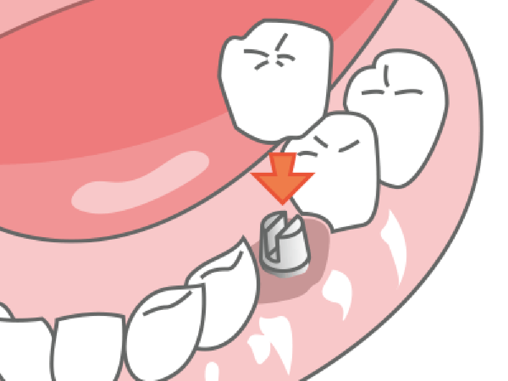 人工の歯を作製・装着