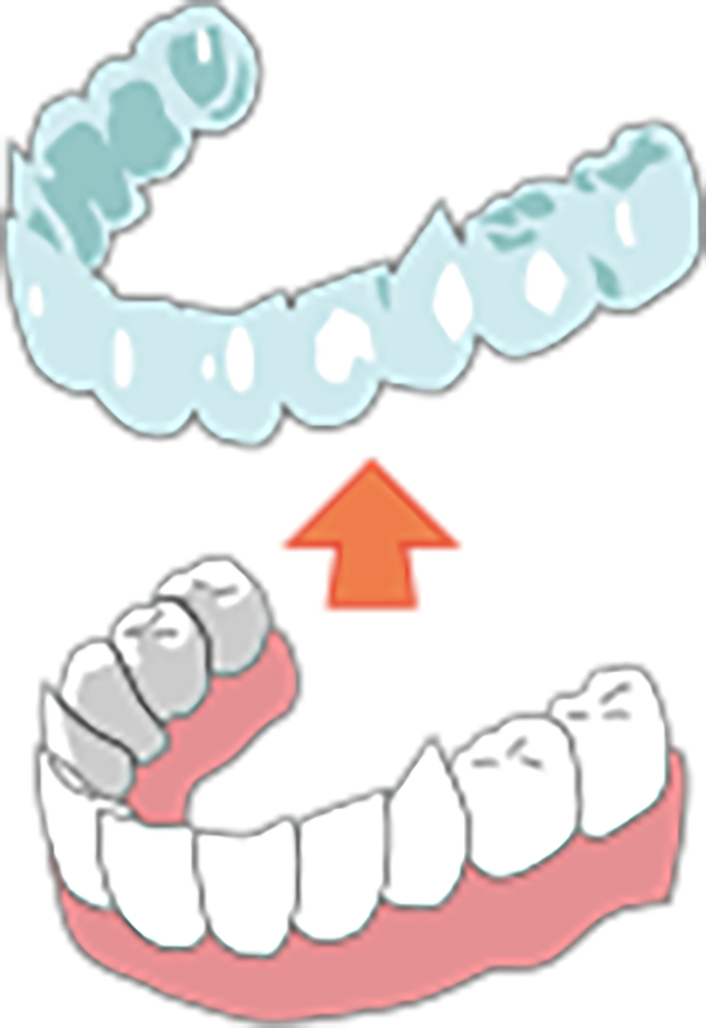 マウスピースの作製