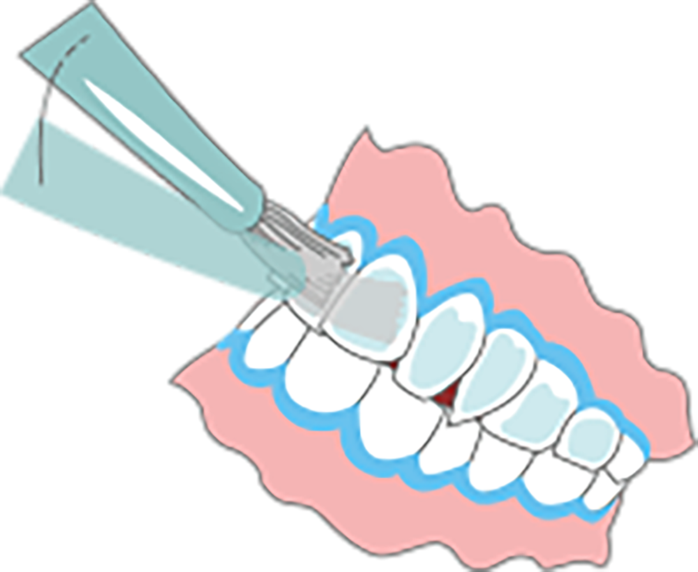 歯肉保護＋ジェル塗布