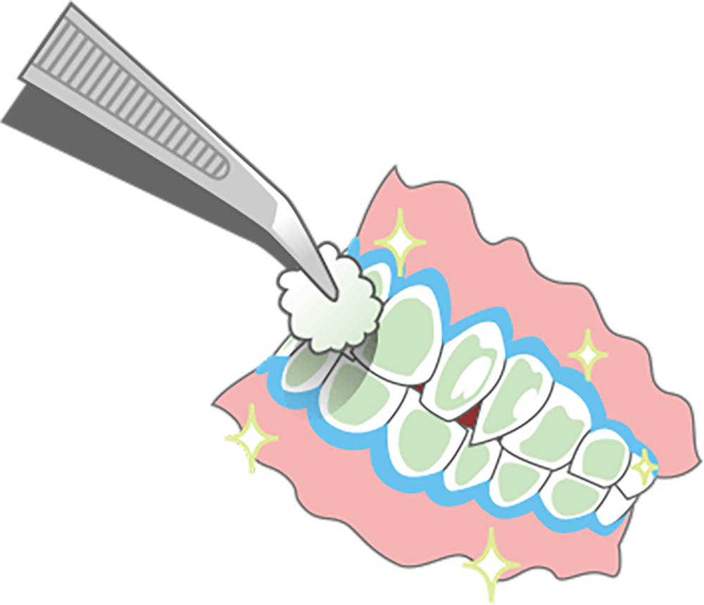 最後に再度、歯の表面を磨き、フッ素コーティングし施術完了後の歯の色の診断を行い、写真を撮って終わり